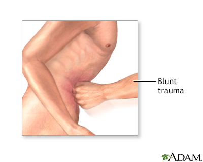 <strong>Diagnostic peritoneal lavage - series</strong><p>Blunt trauma to the abdomen is a major component of traumatic injury and can be deadly. Blunt trauma can occur during falls, motor vehicle accidents, or severe blows to the abdomen.</p> Diagnostic peritoneal lavage - series