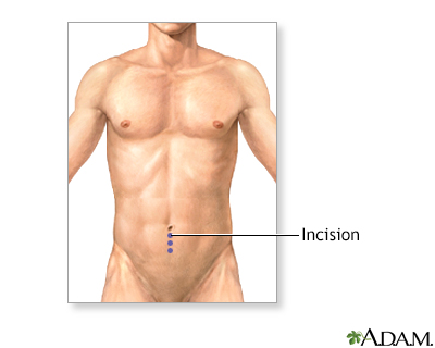 <strong>Incision</strong><p>Often it is difficult to determine if an intra-abdominal injury has occurred in a blunt trauma victim. In many cases, the decision about when to perform an exploratory laparotomy surgery is not straightforward. One procedure used to determine whether blunt trauma victims require surgery is diagnostic peritoneal lavage (DPL). DPL helps determine whether an intra-abdominal injury exists and whether surgery is required. Using local anesthesia, the surgeon makes a small incision in the abdomen just below the umbilicus.</p> Incision