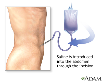 <strong>Procedure, part 1</strong><p>A catheter is introduced through the incision into the abdomen. Saline is infused into the abdomen through the catheter, and then removed. If blood is present in the saline after removal, it is highly probable that there is a serious intra-abdominal injury.</p> Procedure, part 1