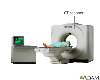 <strong>Procedure, part 2</strong><p>CT scans are also used to detect intra-abdominal injury in trauma patients and are a valuable adjunct to DPL. The combination of DPL and CT scan allows surgeons to minimize the incidence of unnecessary laparotomy in trauma patients.</p> Procedure, part 2